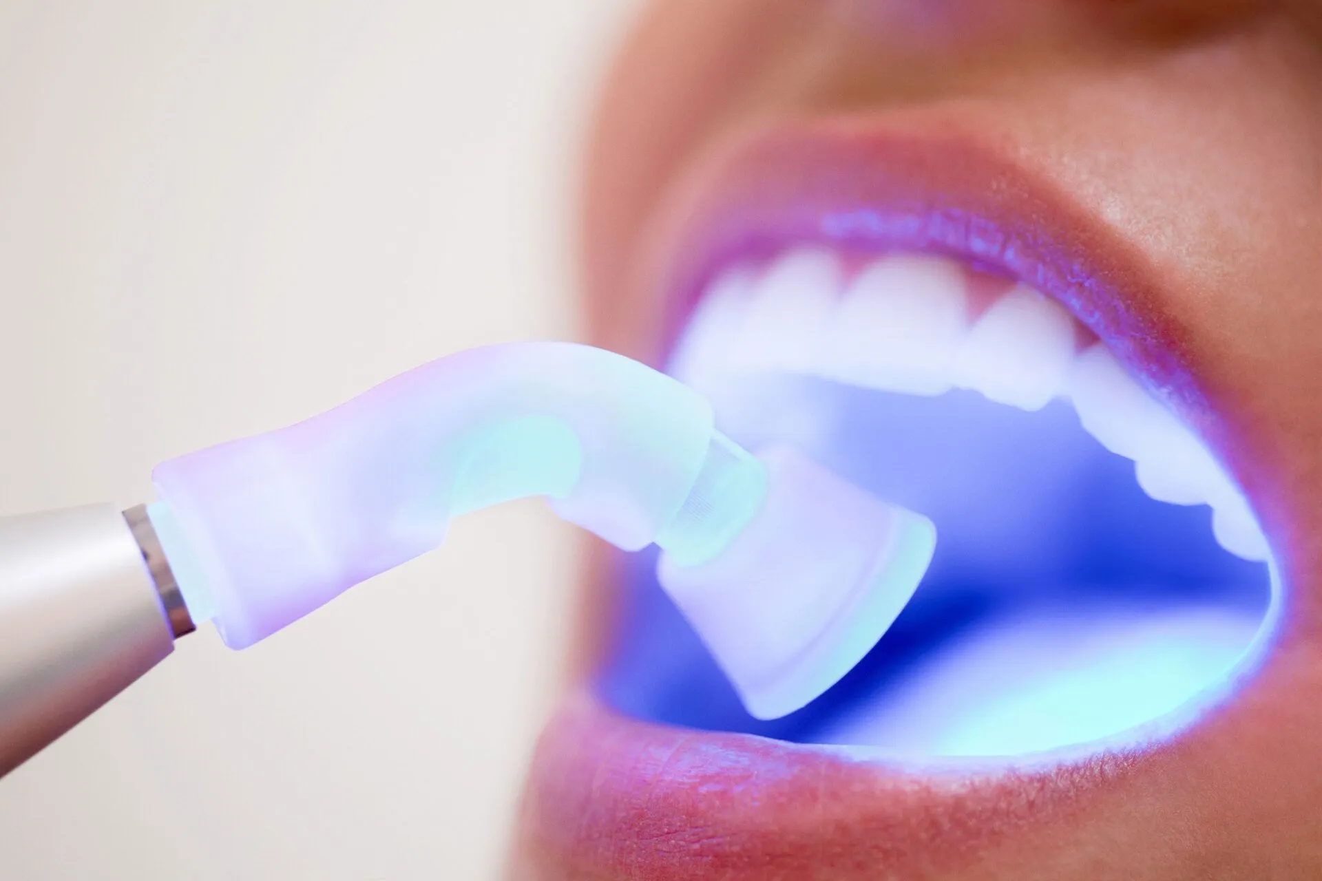 Teeth Whitening